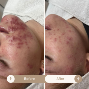 Resultaat acne 